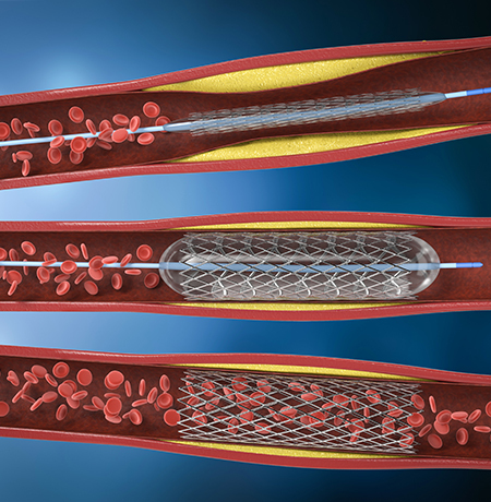 Angiography