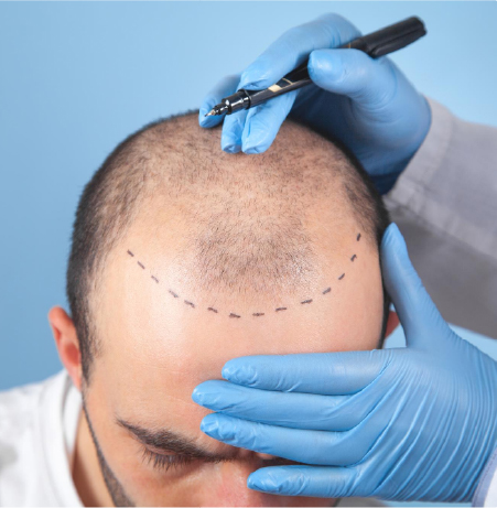 Hair Transplant Surgery