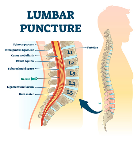 Lumbar Puncture