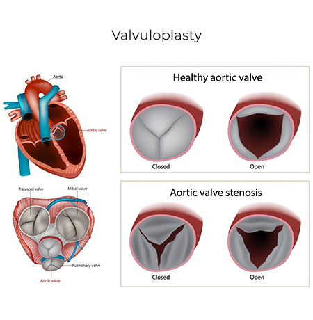 Valvuloplasty