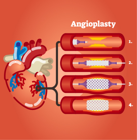 Angioplasty