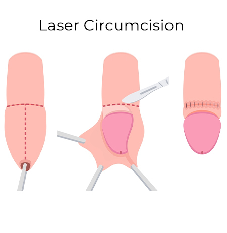 Laser Circumcision